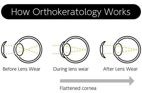 orthokeratology bondi